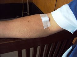 blood extraction